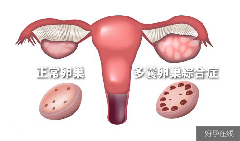 多囊卵巢适合做试管吗