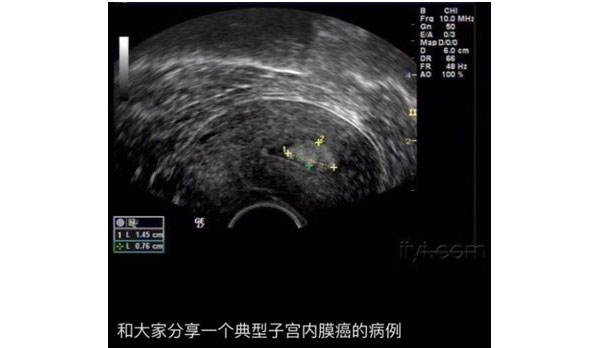 子宫内膜癌的B超呈像