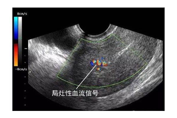 胚胎停育或小产的脏东西呈像