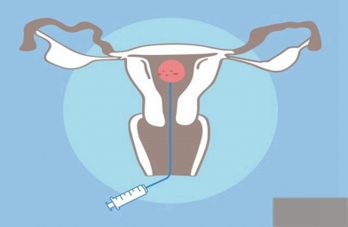 四川为什么在进行试管婴儿手术还是会出现宫外孕？