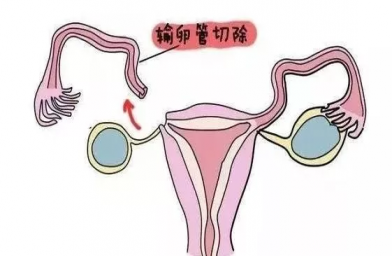 四川慈铭博鳌国际医院三代试管婴儿，切除双侧输卵管还能做试管婴儿吗？